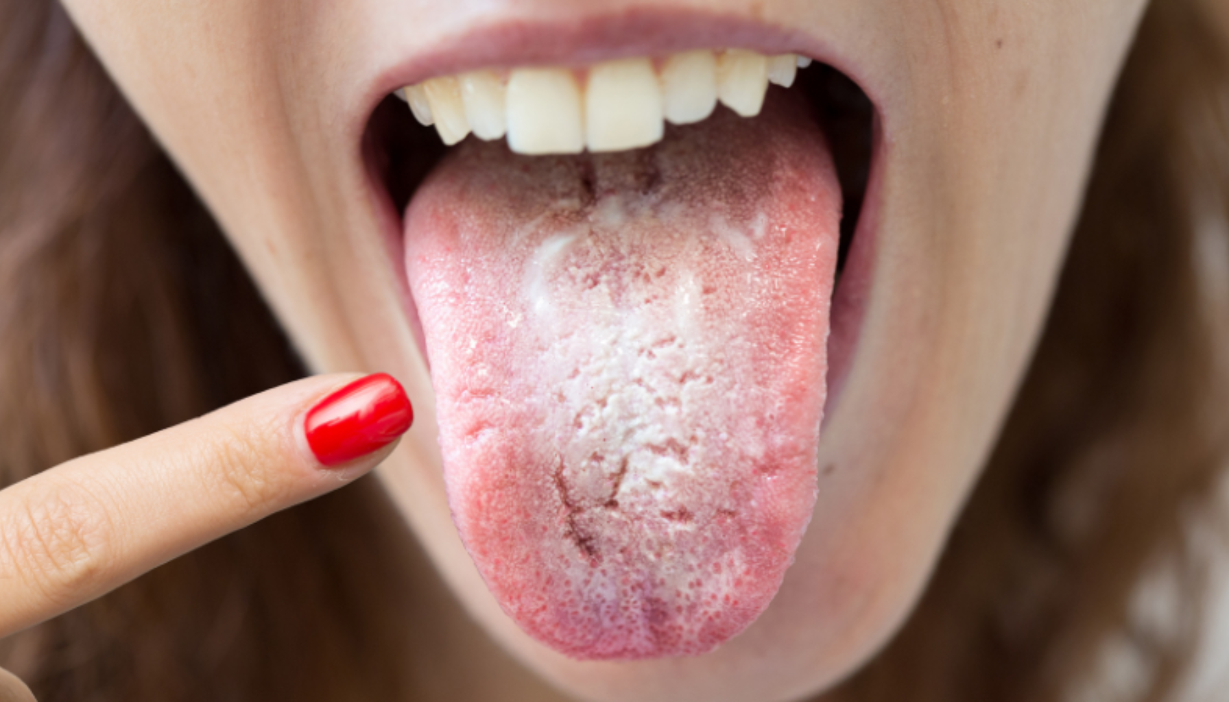Hvitt belegg på tunga ved forkjølelse: Ufarlig, men verdt å følge med på 11 Tunge med tydelig hvitt belegg og irritasjon som kan indikere soppinfeksjon eller ubalanse i munnhygienen.