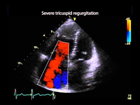 Severe Tricuspid Regurgitation