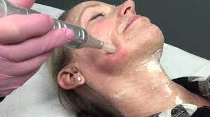 Micro Needling Demonstration - YouTube