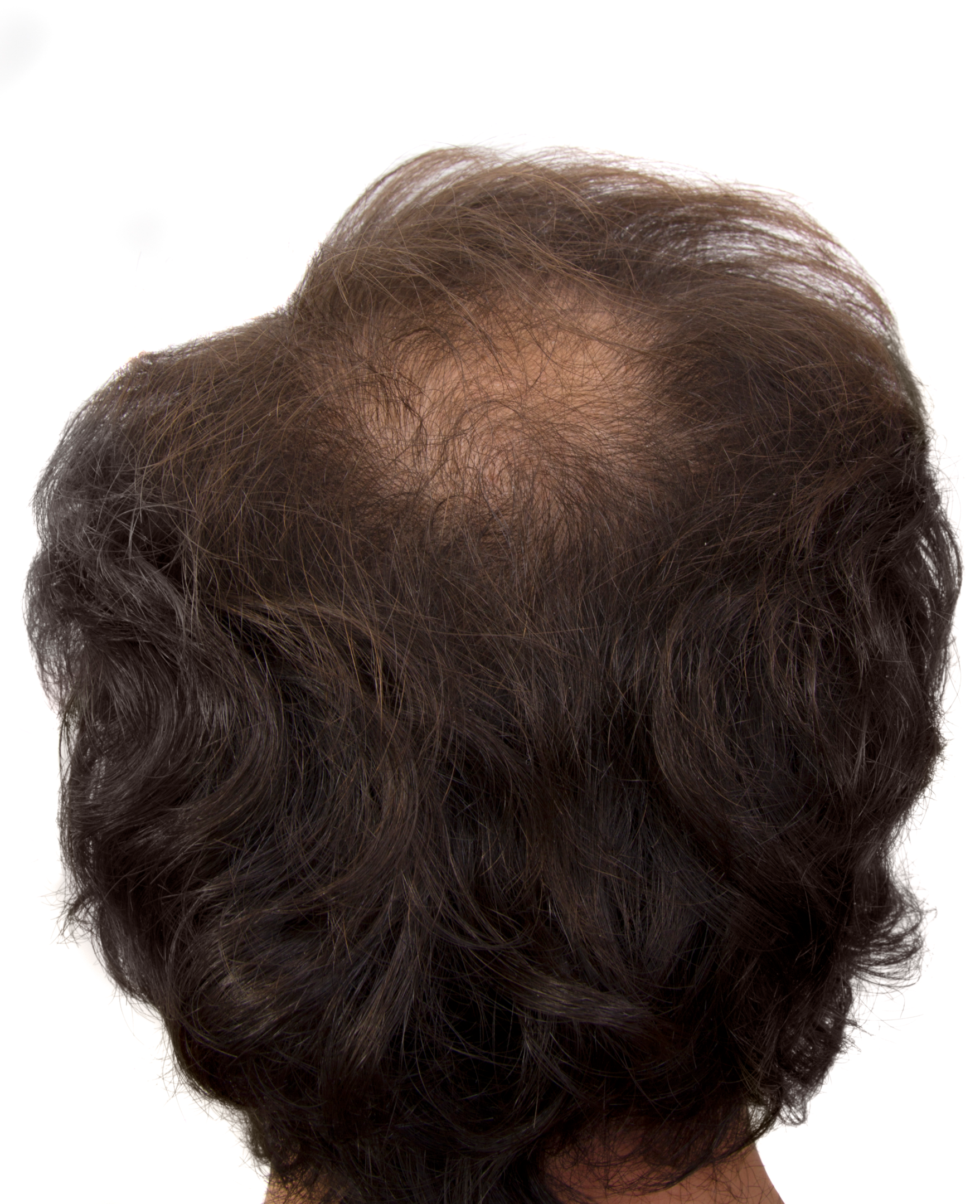 A man with a bald patch on his scalp.