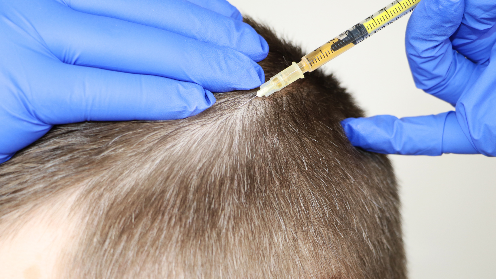 Who is a good candidate for hair transplant surgery?