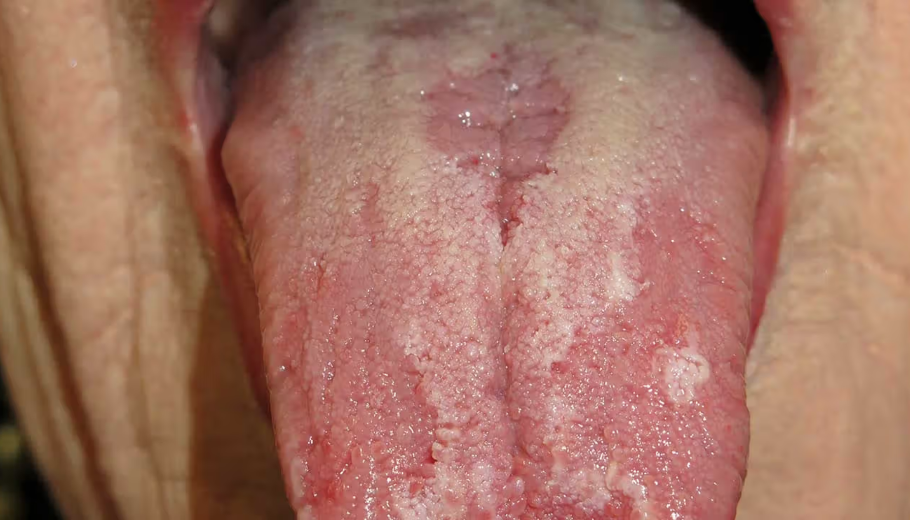 "Tunge med hvite belegg og ujevnheter som kan tyde på infeksjon eller irritasjon."