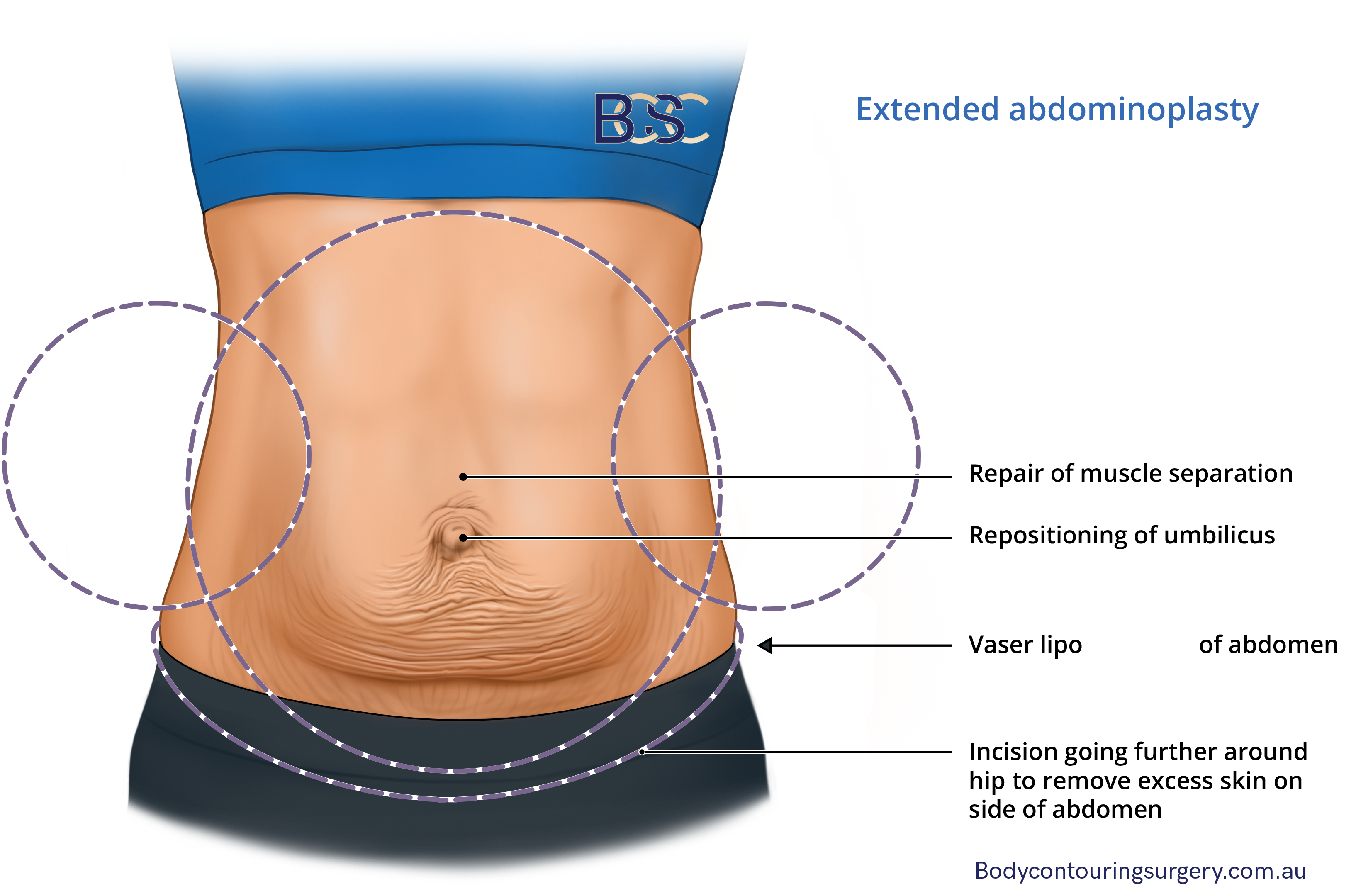 Extended abdominoplasty