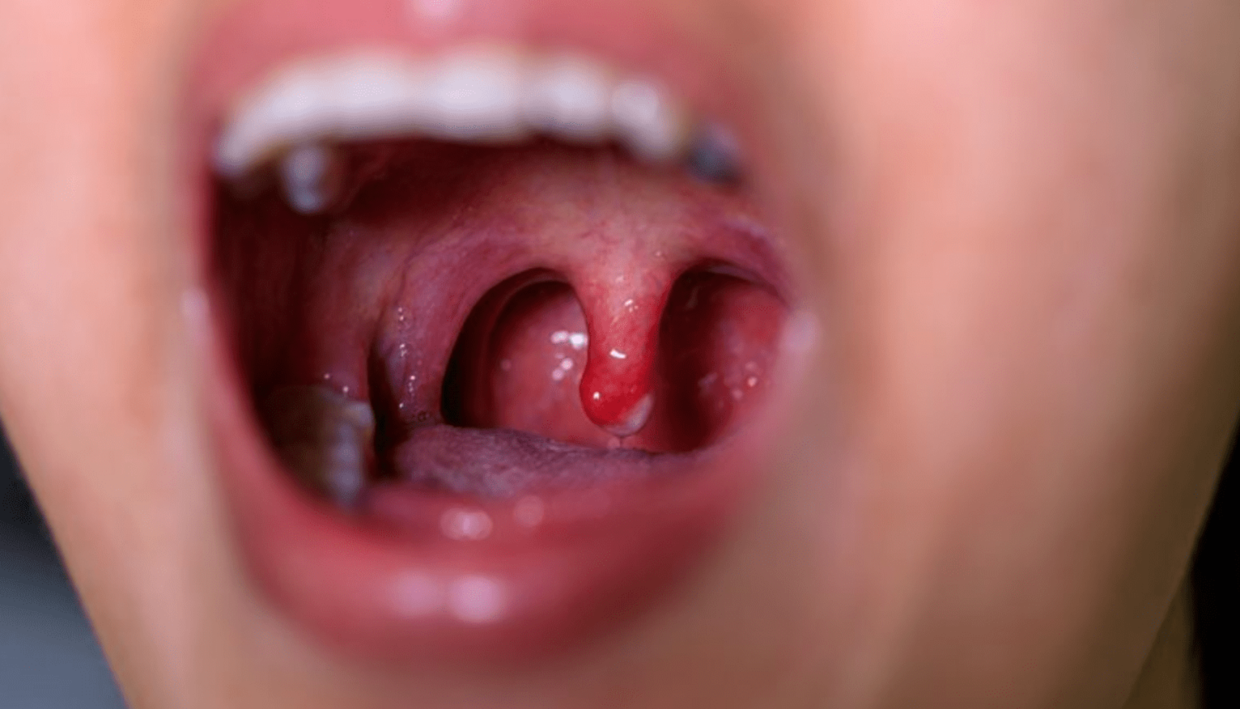 Nærbilde av åpen munn som viser en betent drøvel og rødhet i halsen, typiske tegn på halsinfeksjon eller betennelse.