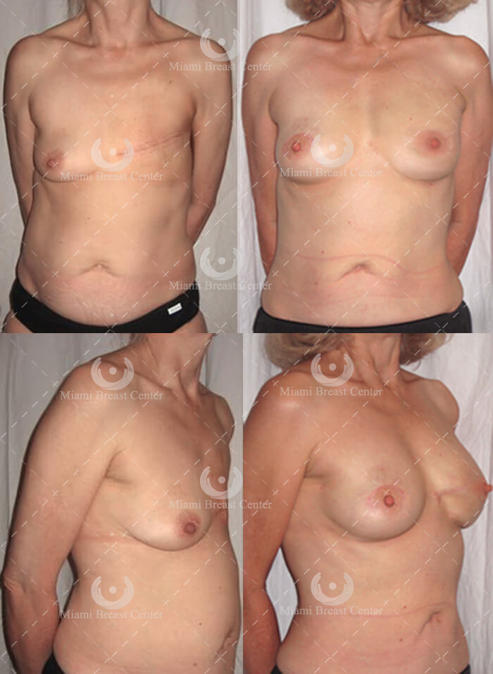 Breast Reconstruction with Fat Grafting by Miami Breast Center