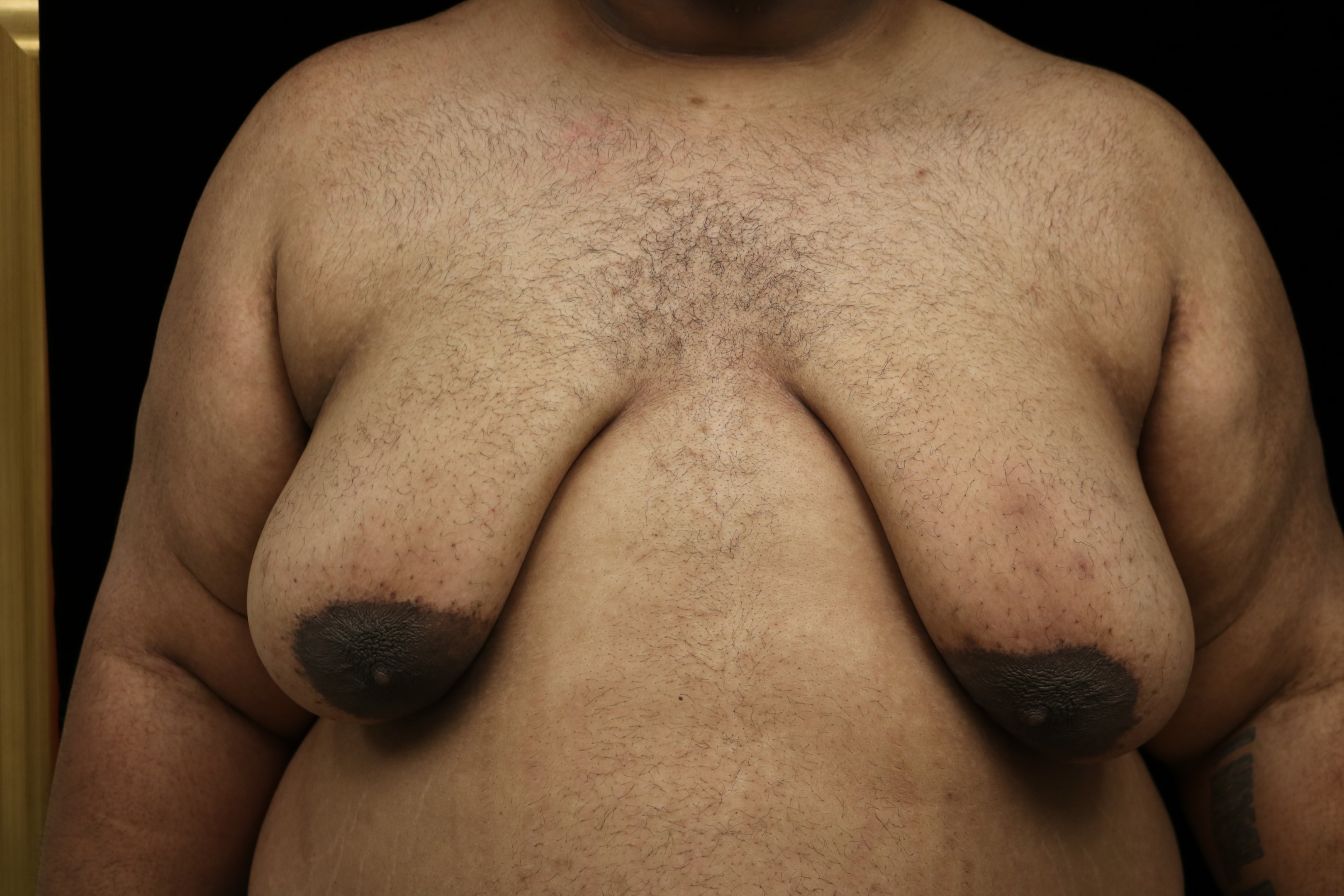 Patient of Dr. Delgado with poor skin elasticity.
