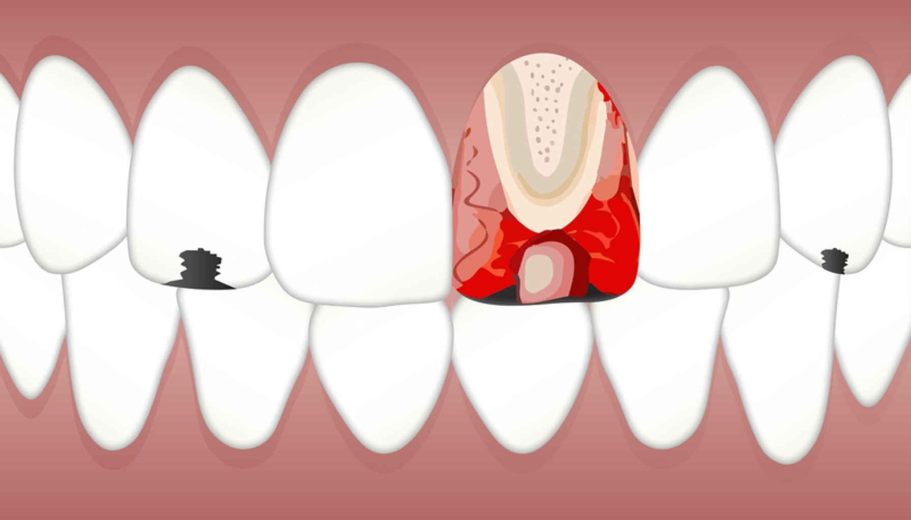 "Illustrasjon av tann med karies og betennelse som viser skade på emalje, dentin og pulpa sammenlignet med friske tenner."