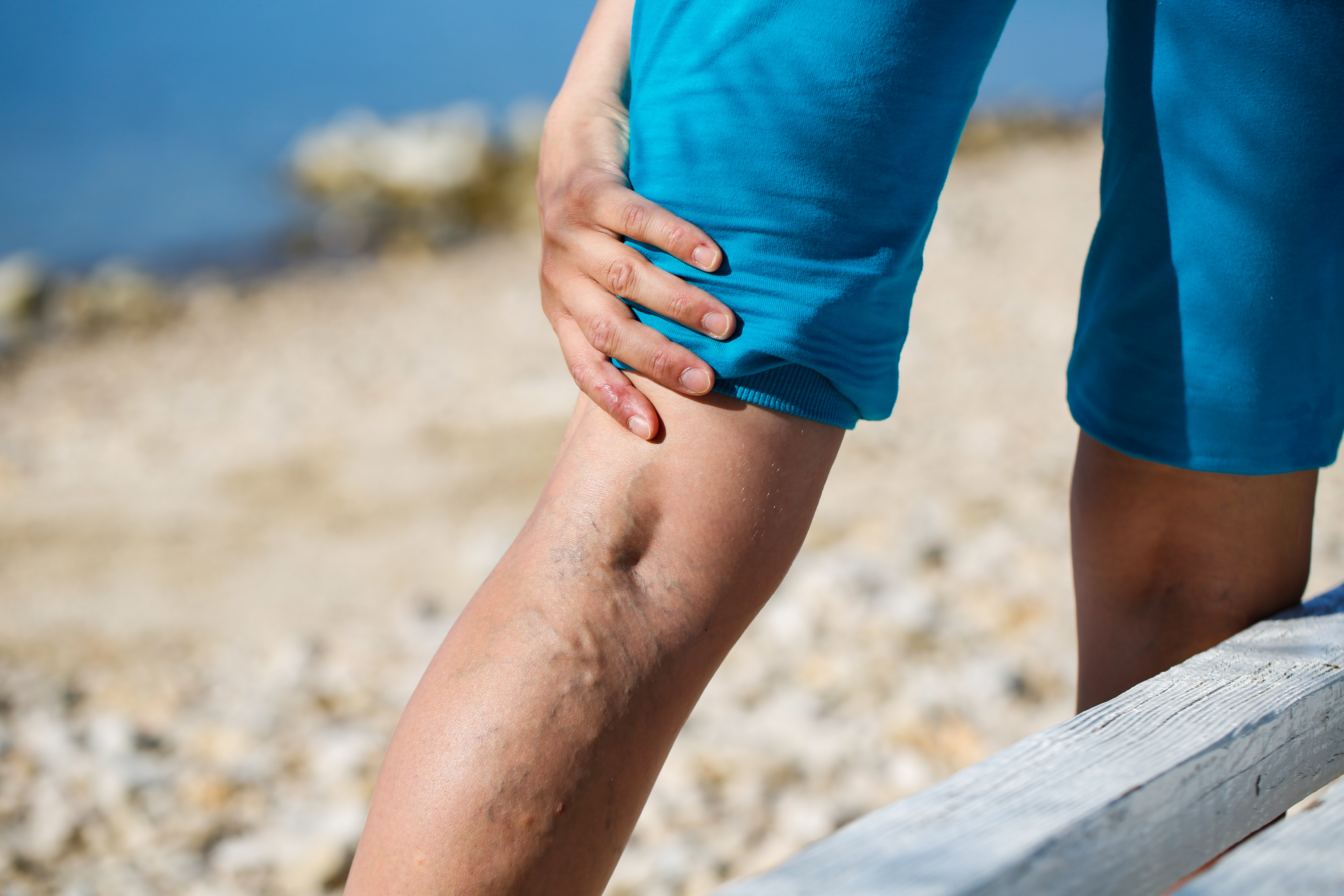 How To Get Relief From Varicose Veins