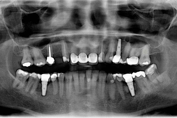 X-ray of patient with dental implants