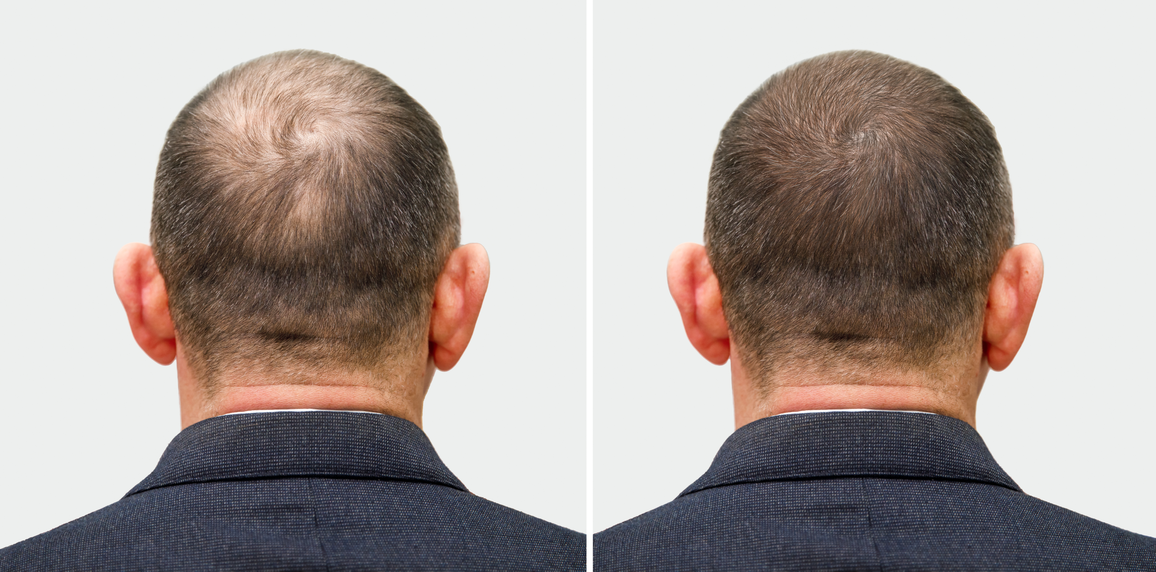 Hair loss treatments take time to work.