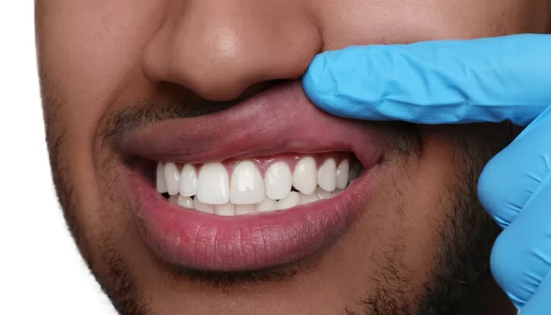 Hvordan Forebygge Tannkjøttbetennelse: En Omfattende Guide 13 Tannlege med blå hansker løfter pasientens overleppe for å undersøke friske, hvite tenner og tannkjøtt.