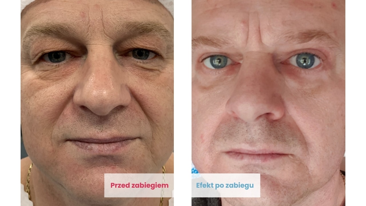 Efekty plastyki powiek górnych u Pacjenta