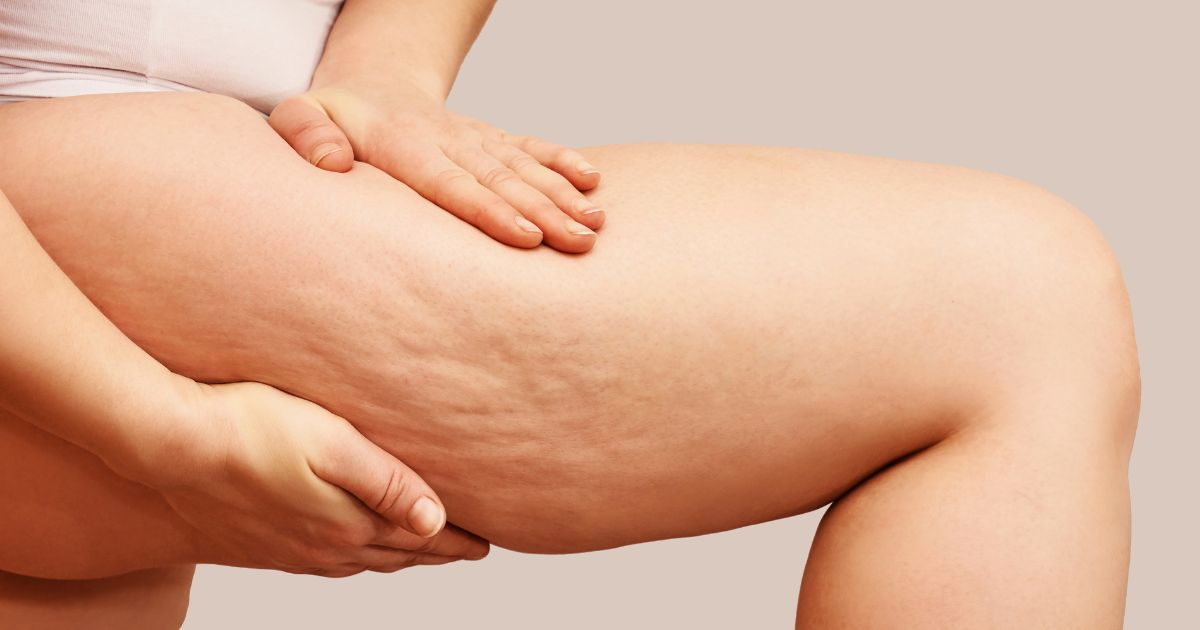 A woman with cellulite on her legs