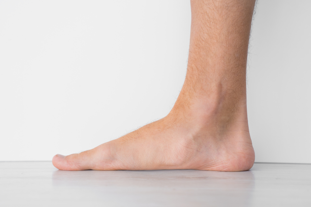complications of flat feet