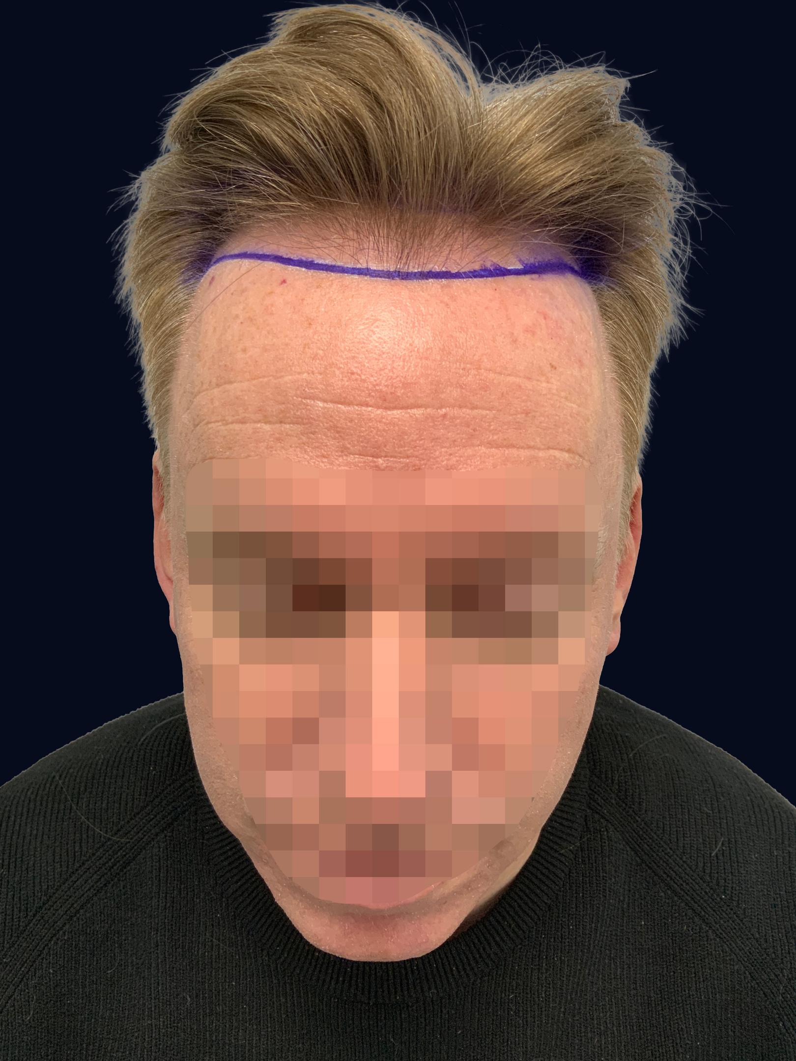 Showing Hairline before Surgery - Dr Kunnure Clinic