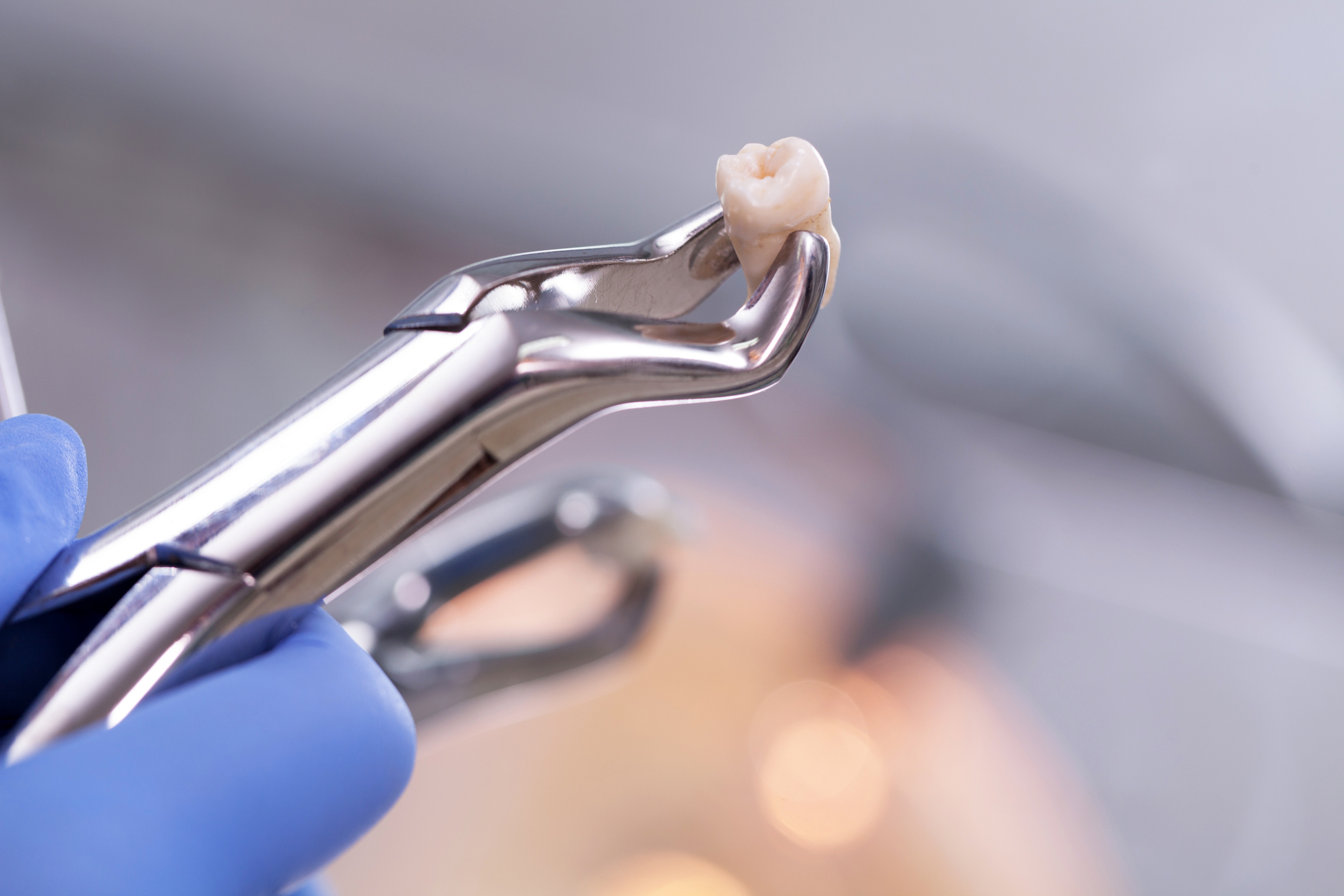dental forceps holding a wisdom tooth that was removed