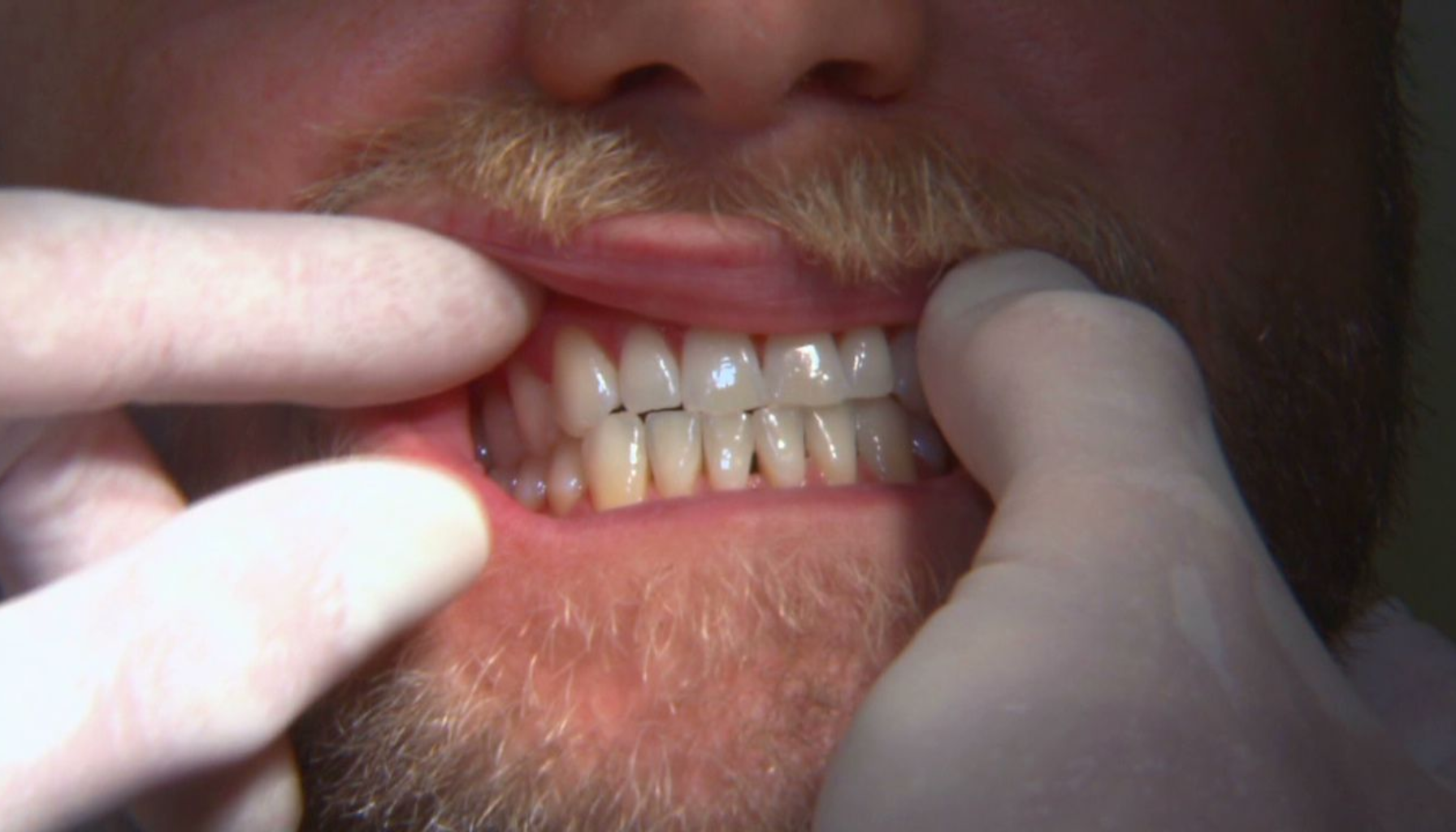 Tannlege vurderer bittkontakter med hansker under undersøkelse på klinikk.