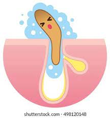 Keratin Plug Pore Stock Illustration 498120148 | Shutterstock