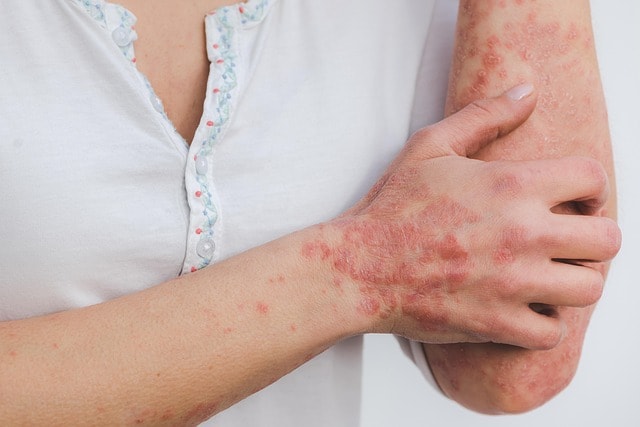 Psoriasis is  a common skin problem