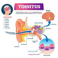 What Causes Tinnitus and How Can I Treat It | Hearing blog