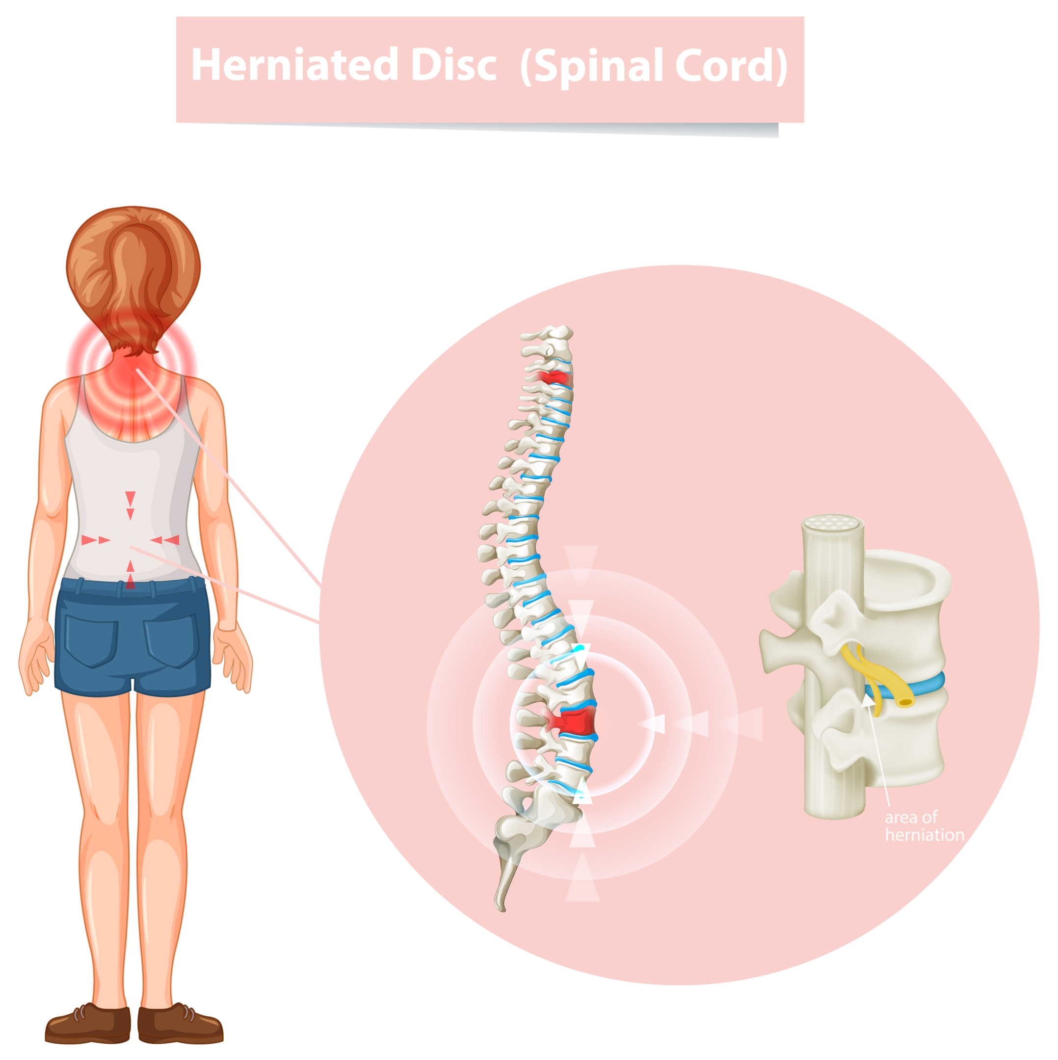 Constant pain due to herniated disc