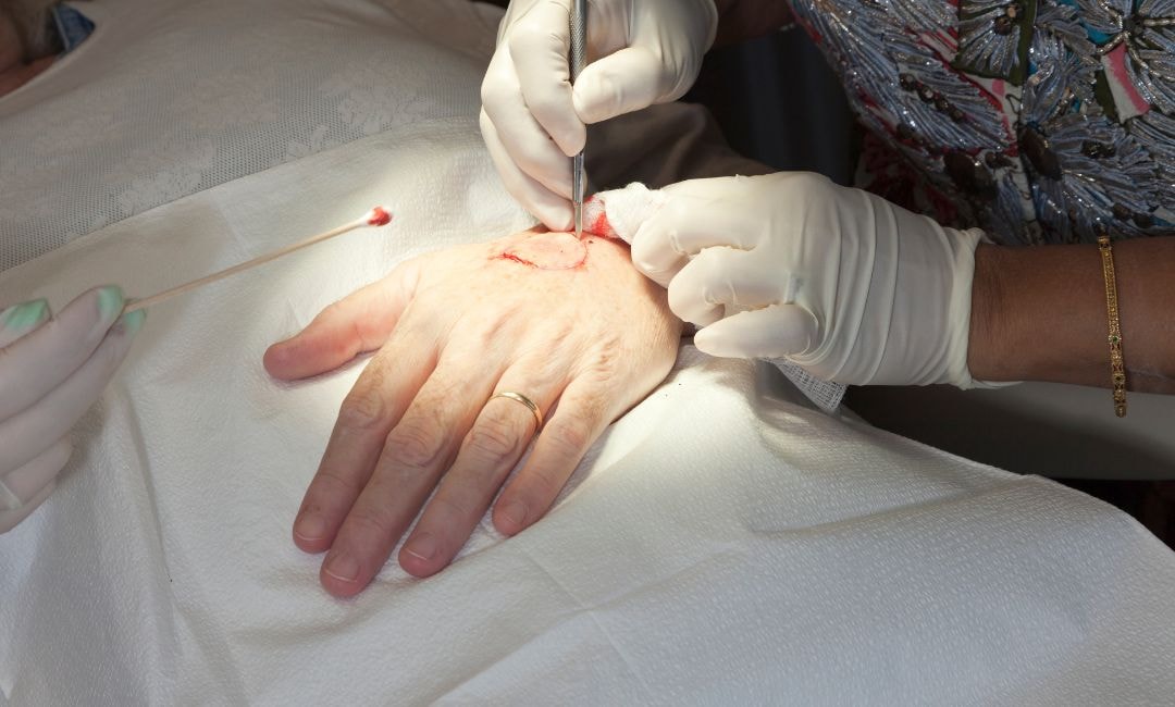 mohs micrographic surgery