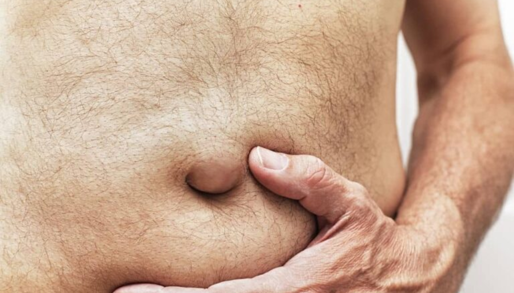 Brokk – Symptomer, typer og behandling 14 "Mann holder magen med synlig navlebrokk som buler ut under huden."