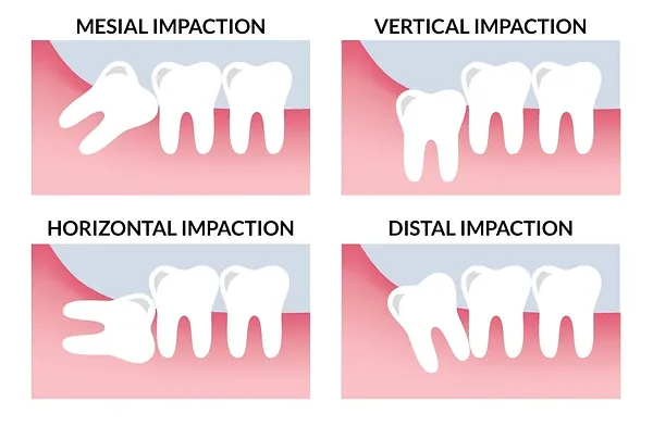 Impacted Wisdom Tooth: Types, Causes, Symptoms, Risks & Treatment
