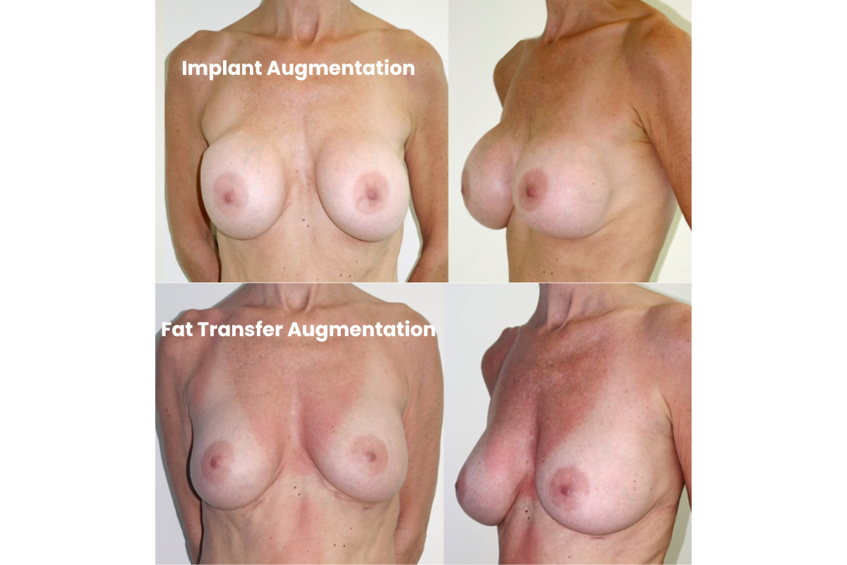 Breast Implant vs Fat Transfer Breast Augmentation