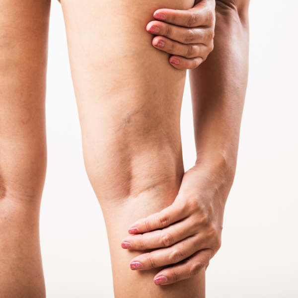 Image of someone with swelling in their legs.