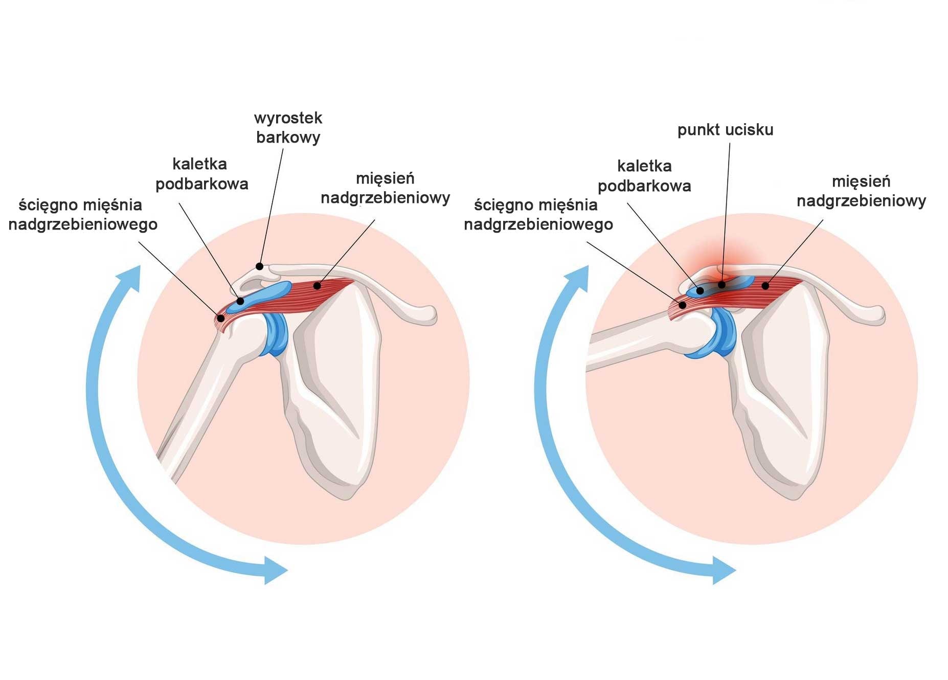 Zespół bolesnego barku – wyjaśnienie objawów