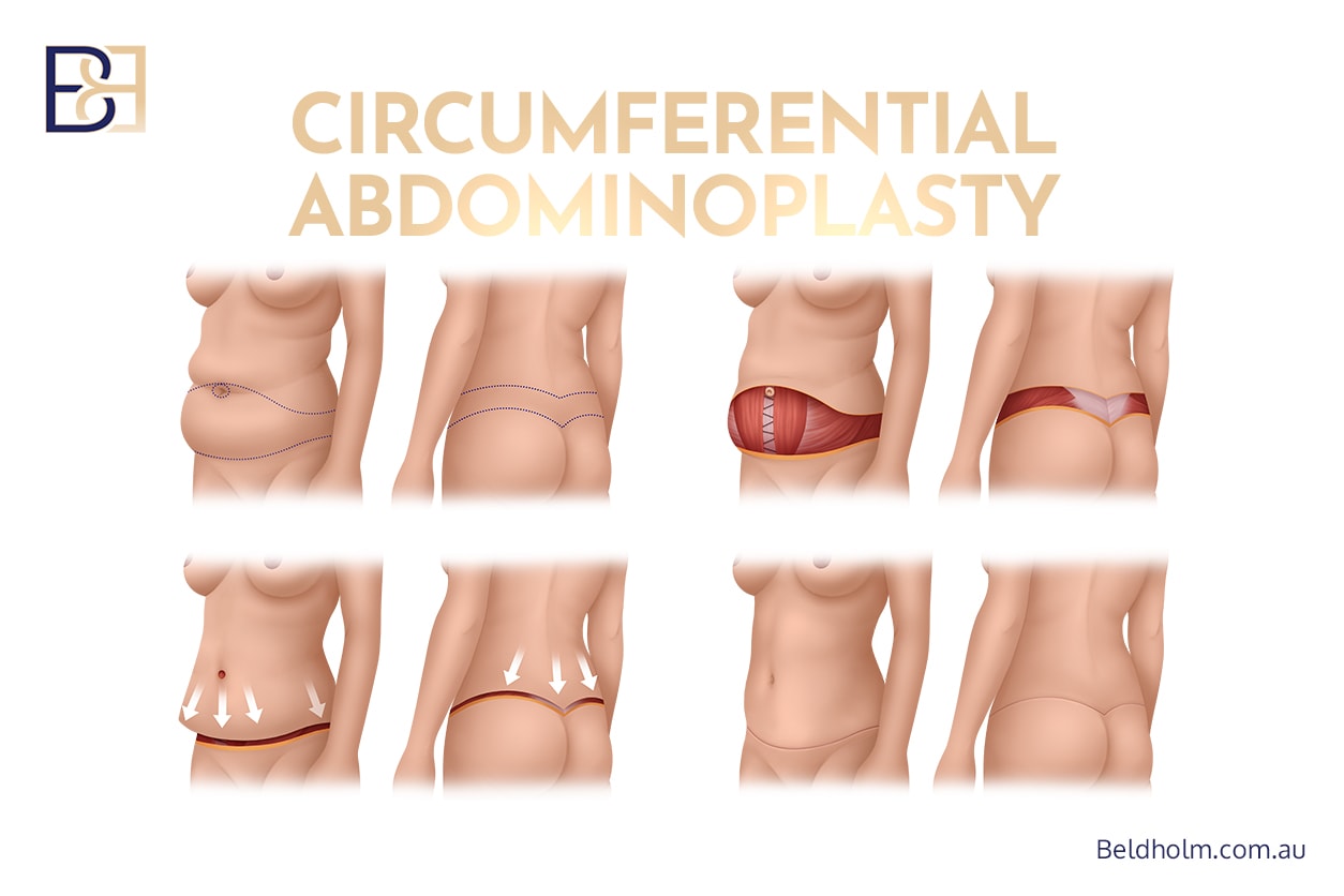 Circumferential abdominoplasty (belt lipectomy)