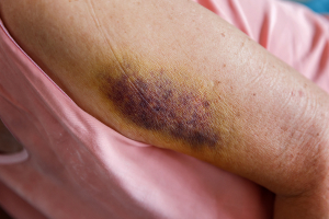 Unsual bruises scratches or other injuries