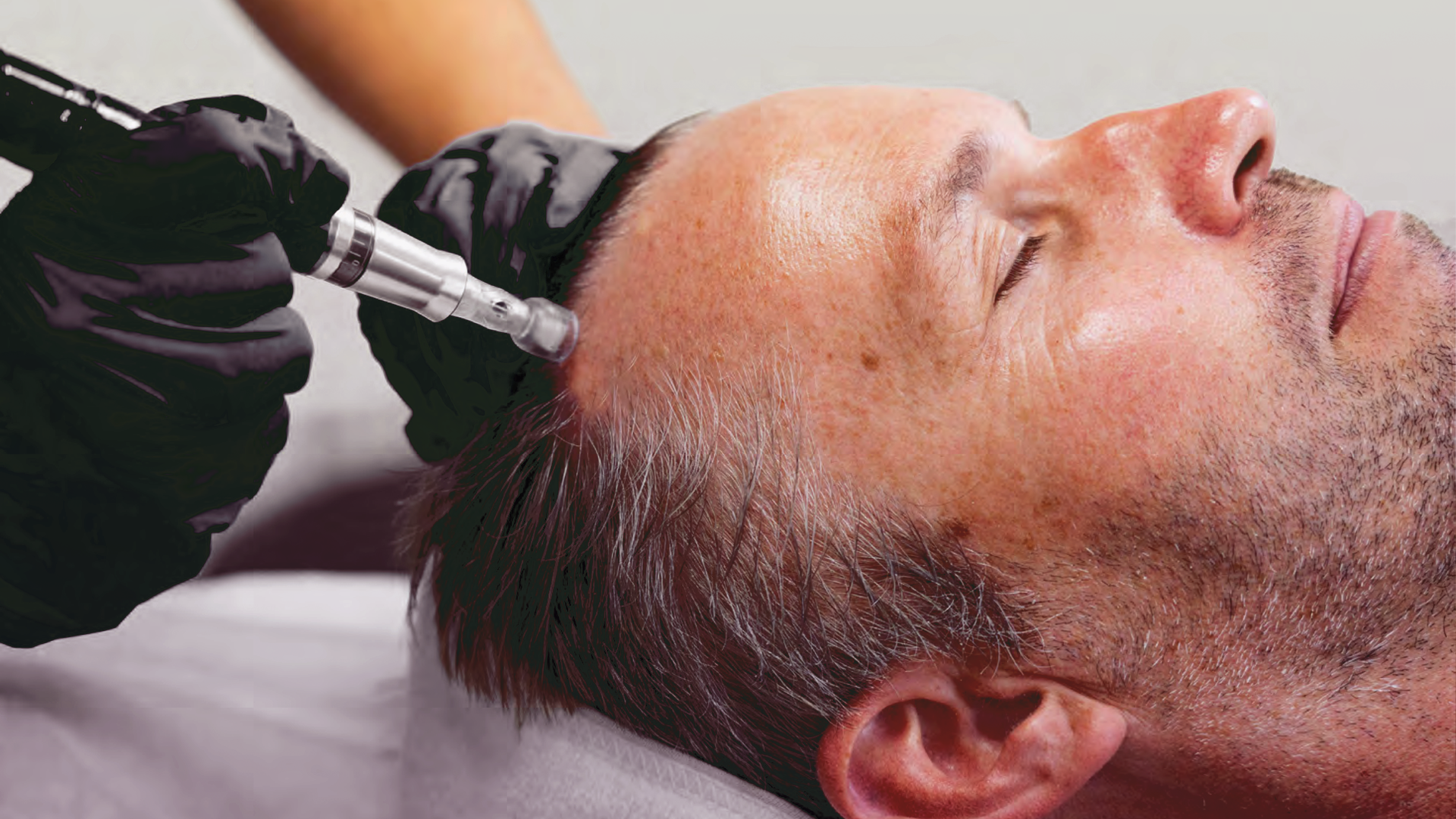 An image of exosome hair restoration, showcasing hair follicles and growth factors.