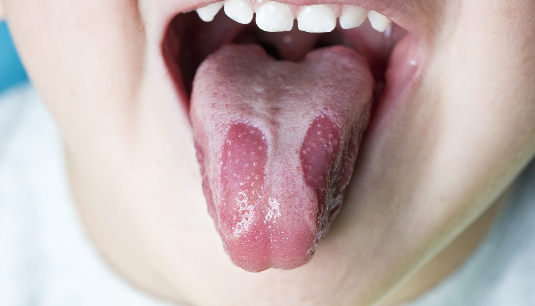 Glossitt – Når tungen blir betent og smertefull 17 Barn med åpen munn viser tunge med tydelige folder og papiller, nærbilde av munnhule og tenner.