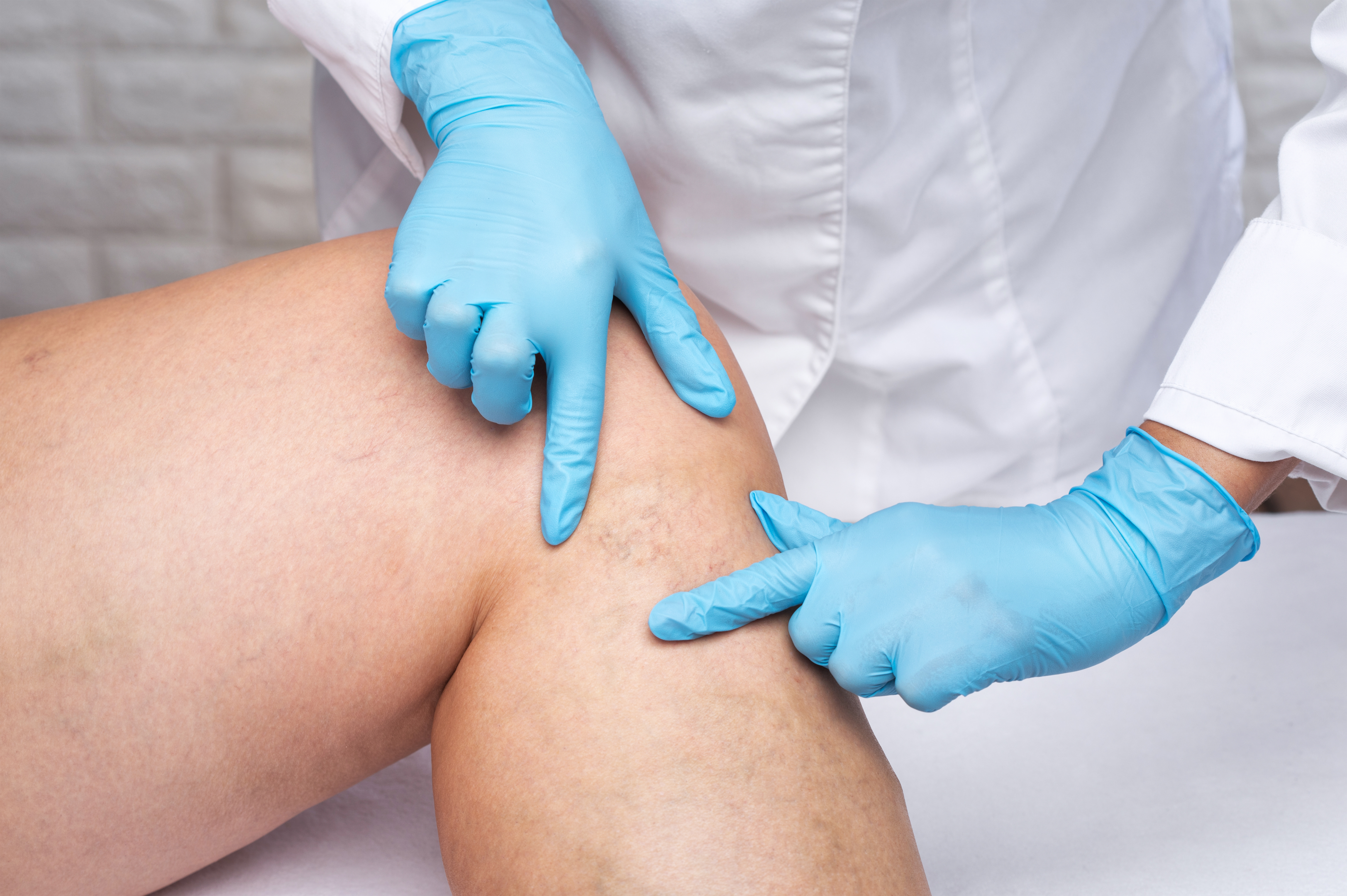 How To Get Relief From Varicose Veins