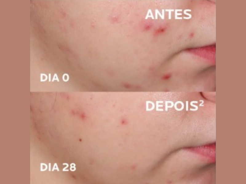 Antes e depois La Roche-Posay Effaclar Ultra Concentrado - Sérum Antiacne - Imagem: www.laroche-posay.com.br.