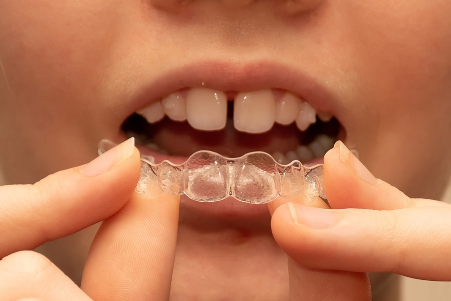 Young patient about to weak invisalign