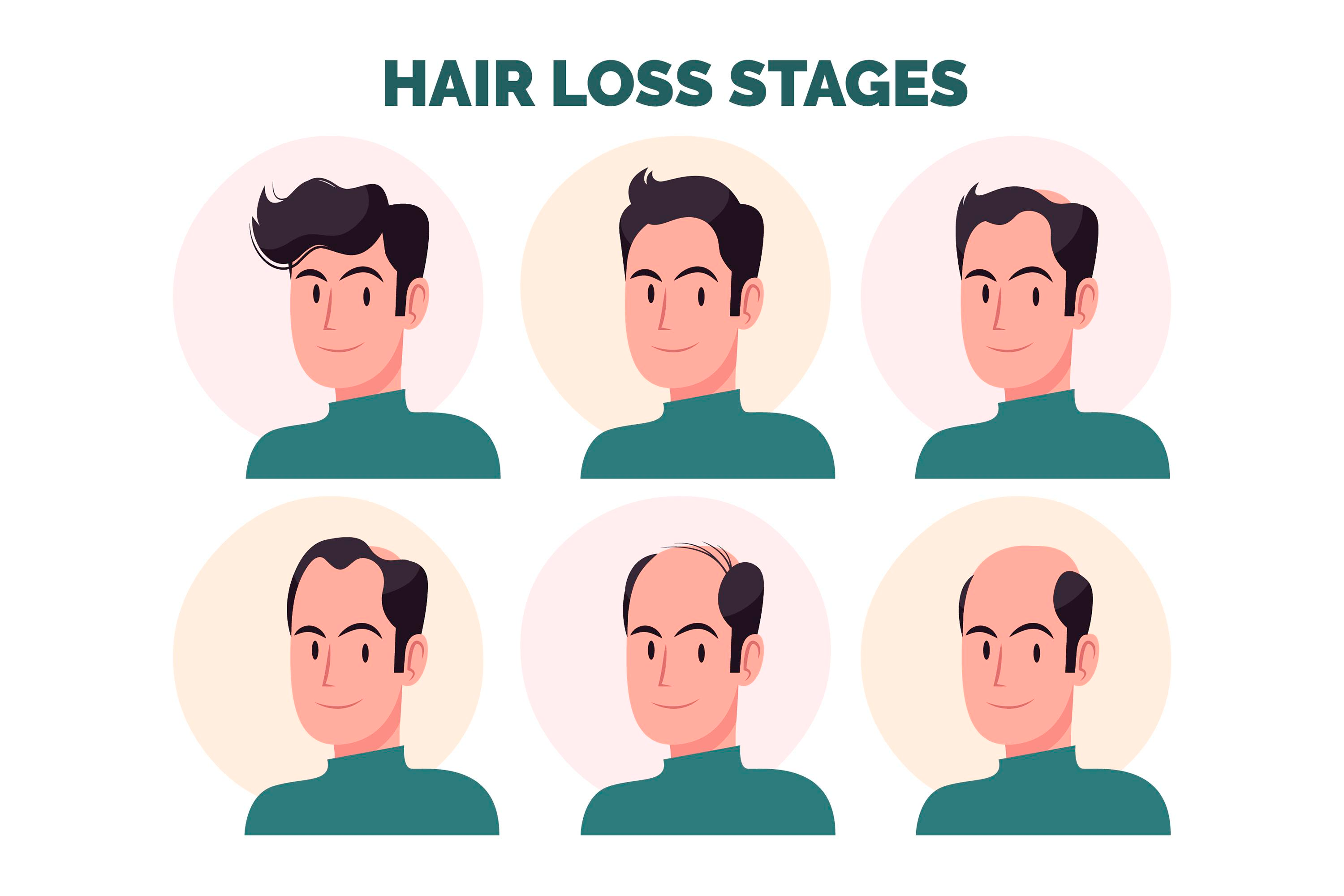 Stages of hair loss