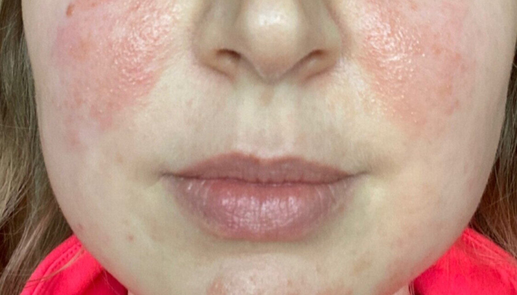 Periorifisiell Dermatitt: Det Uforklarlige Utslettet Rundt Munnen 14 Rødhet og betennelse på begge kinn, mulige tegn på hudtilstand som rosacea eller perioral dermatitt hos voksen kvinne.