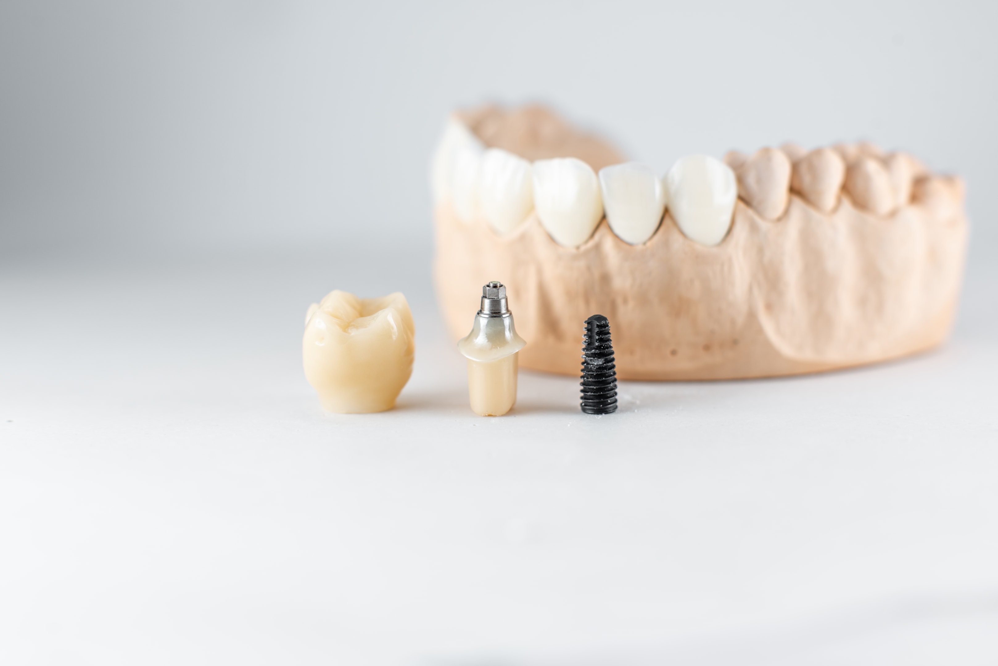 a deconstructed dental implant to aid patient in better visualizing the artificial tooth
