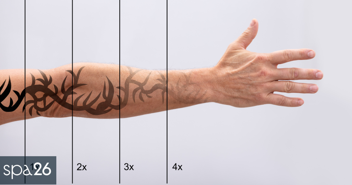 What Factors Affect the Number of Tattoo Removal Sessions?