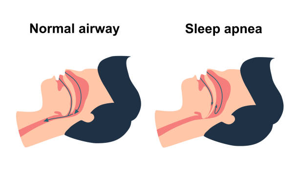 Illustration contrasting normal airway and blocked airway.