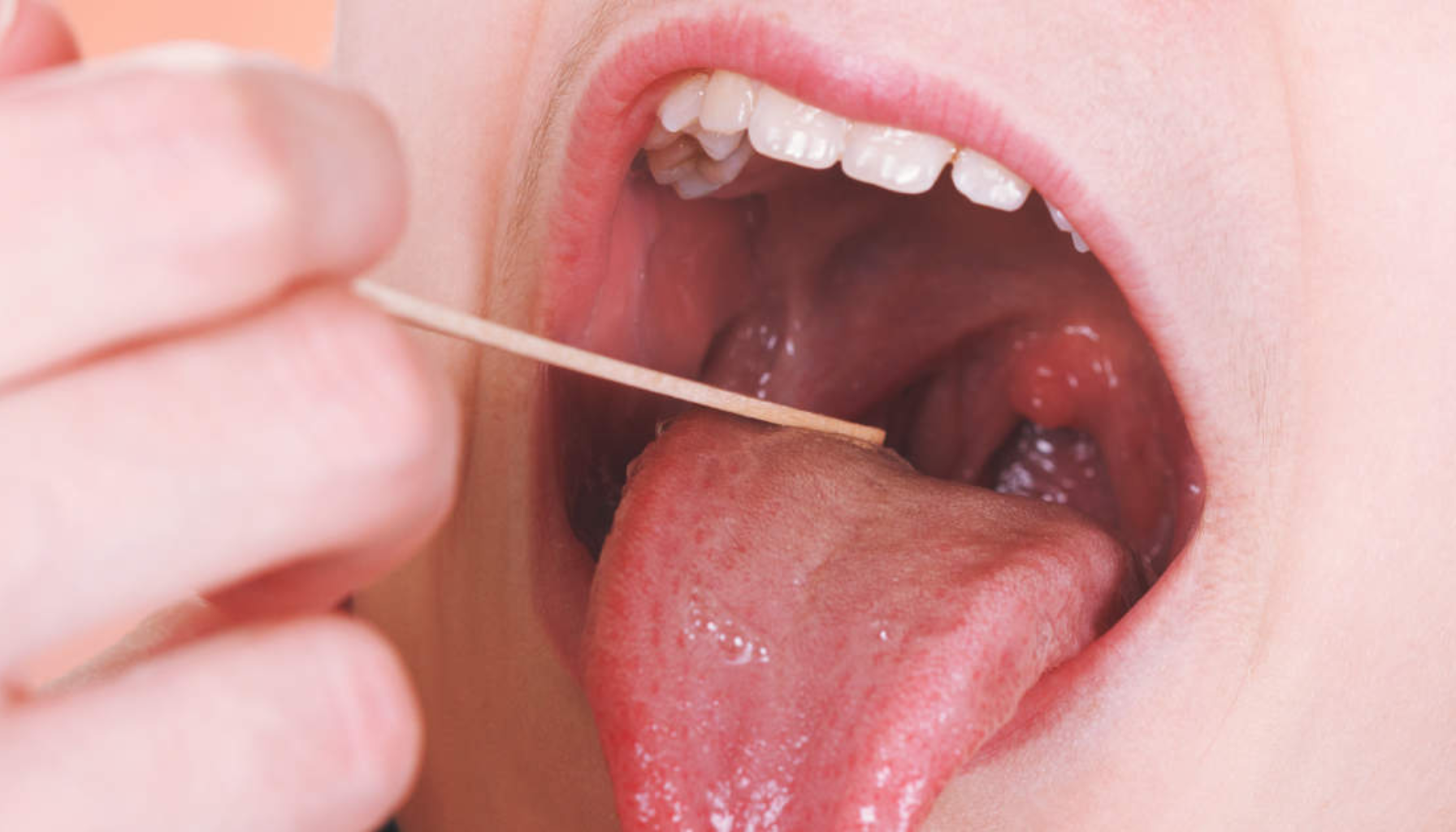 Nærbilde av åpen munn der legen undersøker halsen med en trepinne, fokus på tunge og mandler. hovne mandler sår hals bør du kontakte hos barn kontakte lege lymfeknuter på halsen oppsøke lege vond hals høy feber andre symptomer halsbetennelse går vanligvis hvite flekker mandler mandlene hovne symptomer barn halsen hos antibiotika legen bør andre lege feber virus får vanligvis behandling går betennelse bakterier dager ofte vanlig dersom symptomene mer tonsillitt infeksjon unngå gir smerter forårsaket viktig skyldes voksne lymfeknuter streptokokker ganger tilfeller fleste svelg gjøre alvorlig behandlingen eksempel kommer sykdommen oftest bedre regel drikke aktuelt svært gjennom dine grunn brukes under forkjølelse smitte svelget reseptfrie