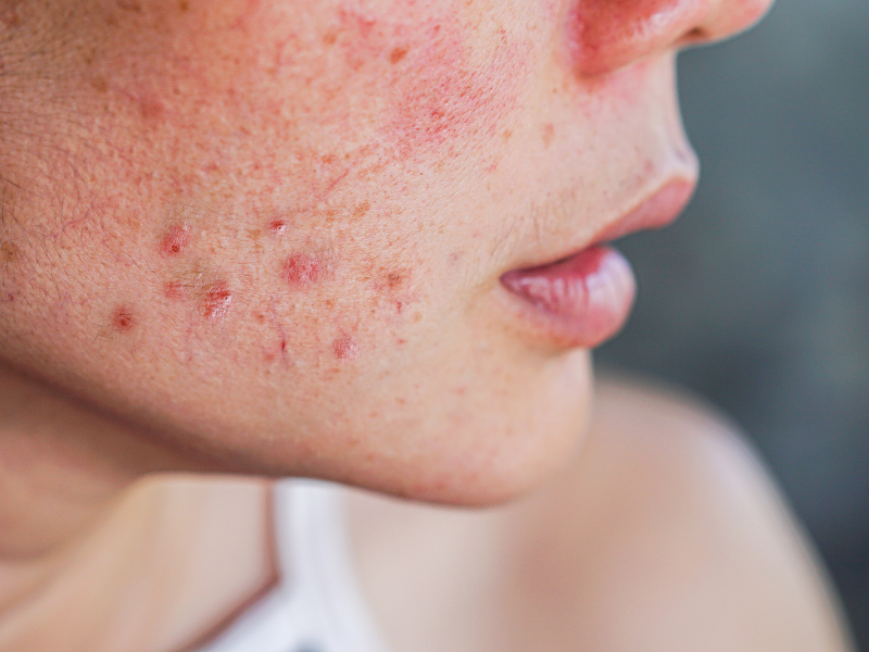 Pele acneica e cicatrizes causadas por acnes. Imagem: dolcefleur de dolcefleur's Images - Canva.