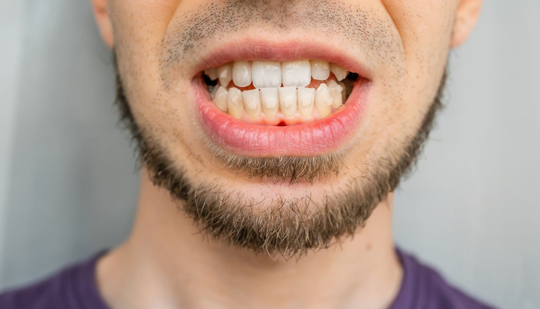 Stygge tenner: Årsaker, løsninger og hvordan du får smilet tilbake 4 Mann viser tennene tett sammenbitte med synlig kjeve og skjeggstubb i nærbilde.