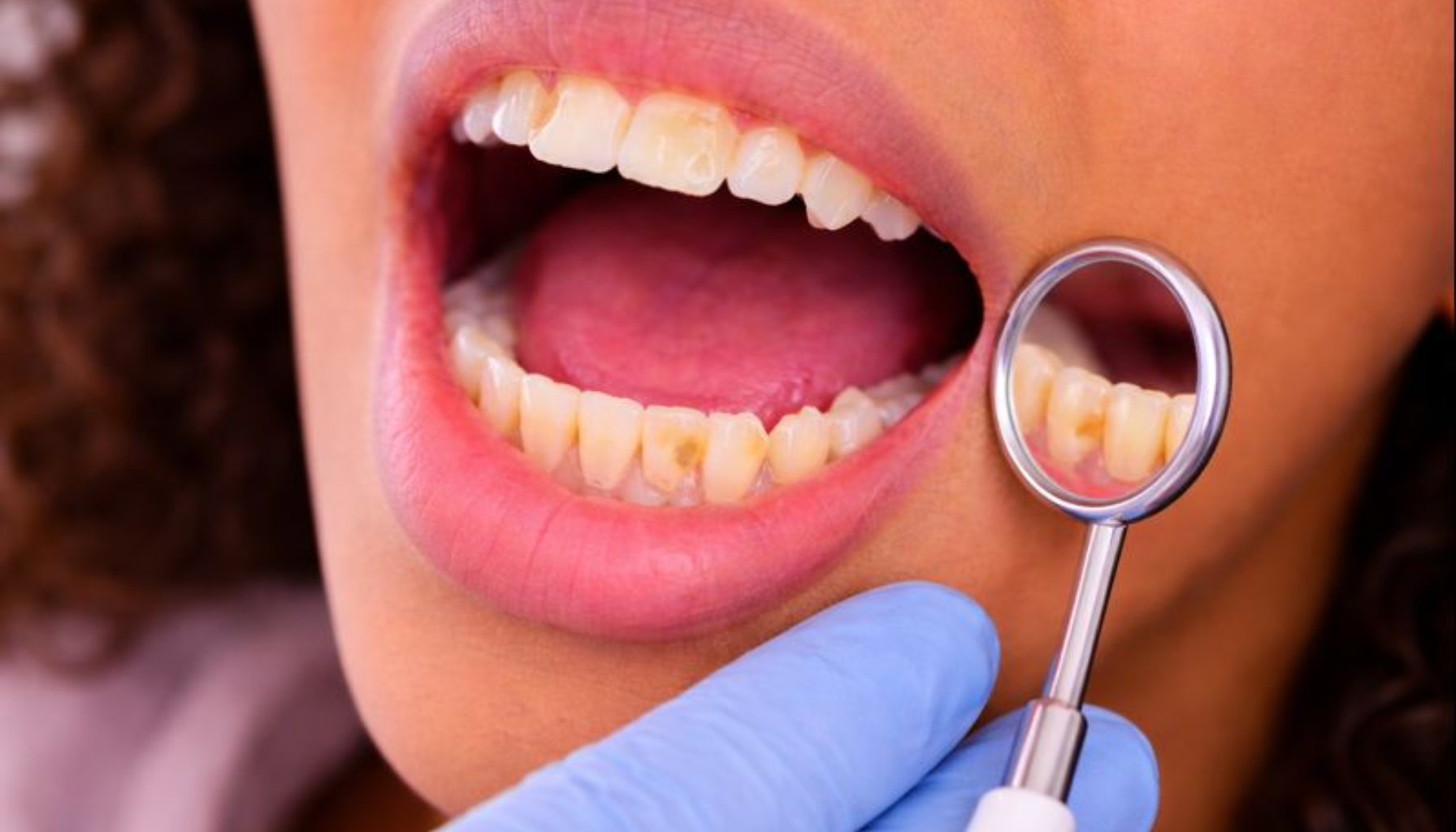 Syreskader Tenner: Når Emaljen Brytes Ned Over Tid 9 Nærbilde av tenner med emaljeskader undersøkt med speil, viser syreskade som utvikles over tid.