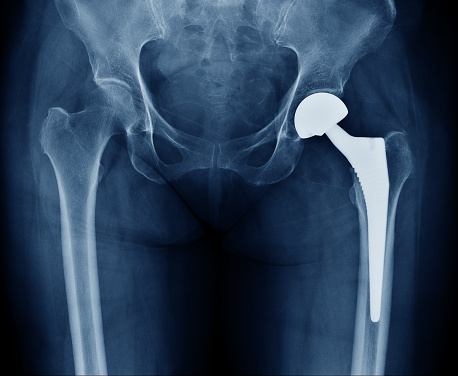 hip replacement recovery time
