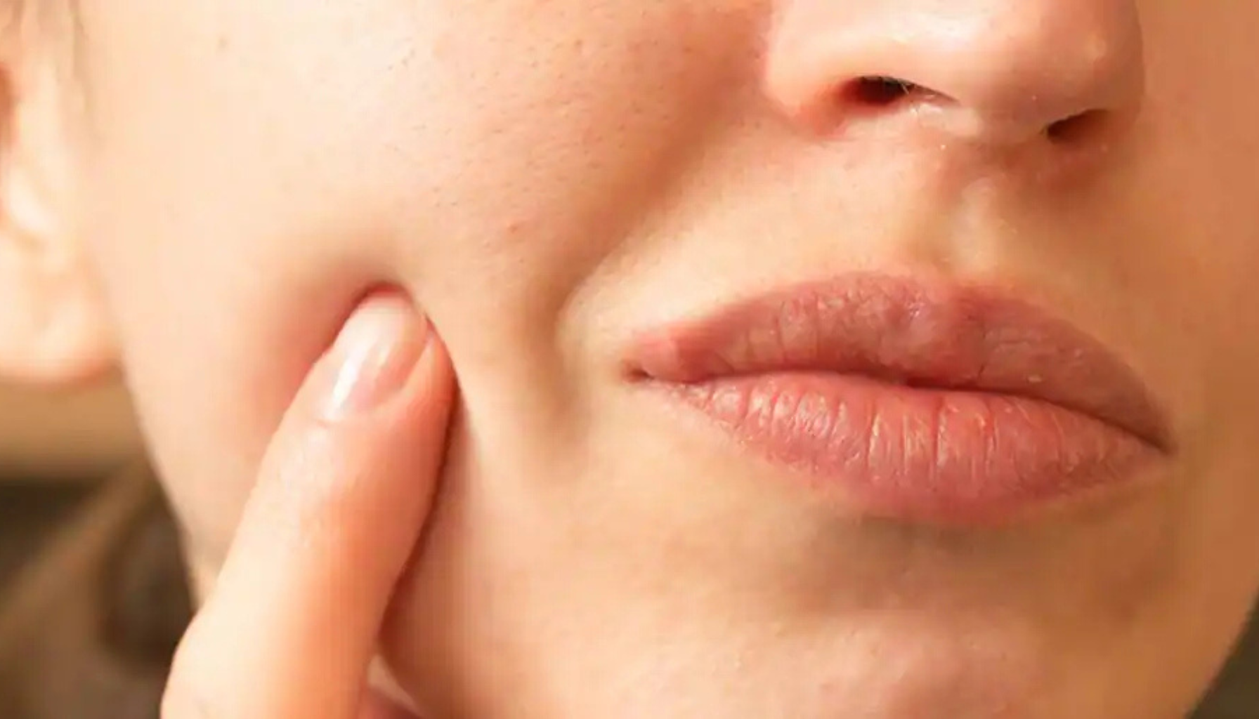 Hevelse på overleppe med blemme.