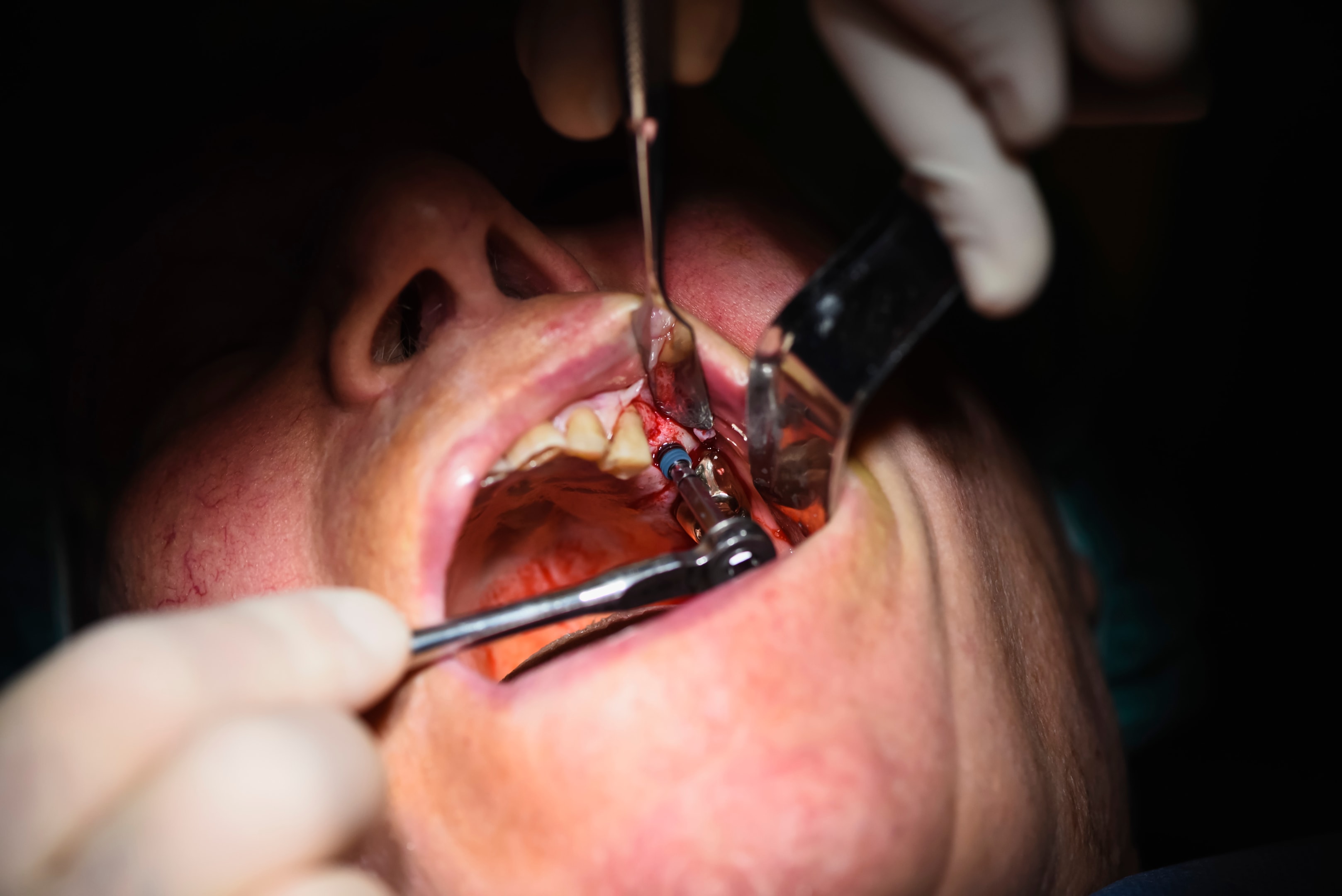 Person getting teeth extracted